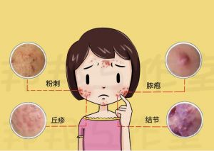 諷刺痤瘡 諷刺痤瘡